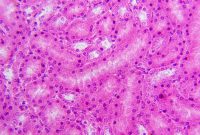 How Can Nutrition Affect Chronic Disease Prevention